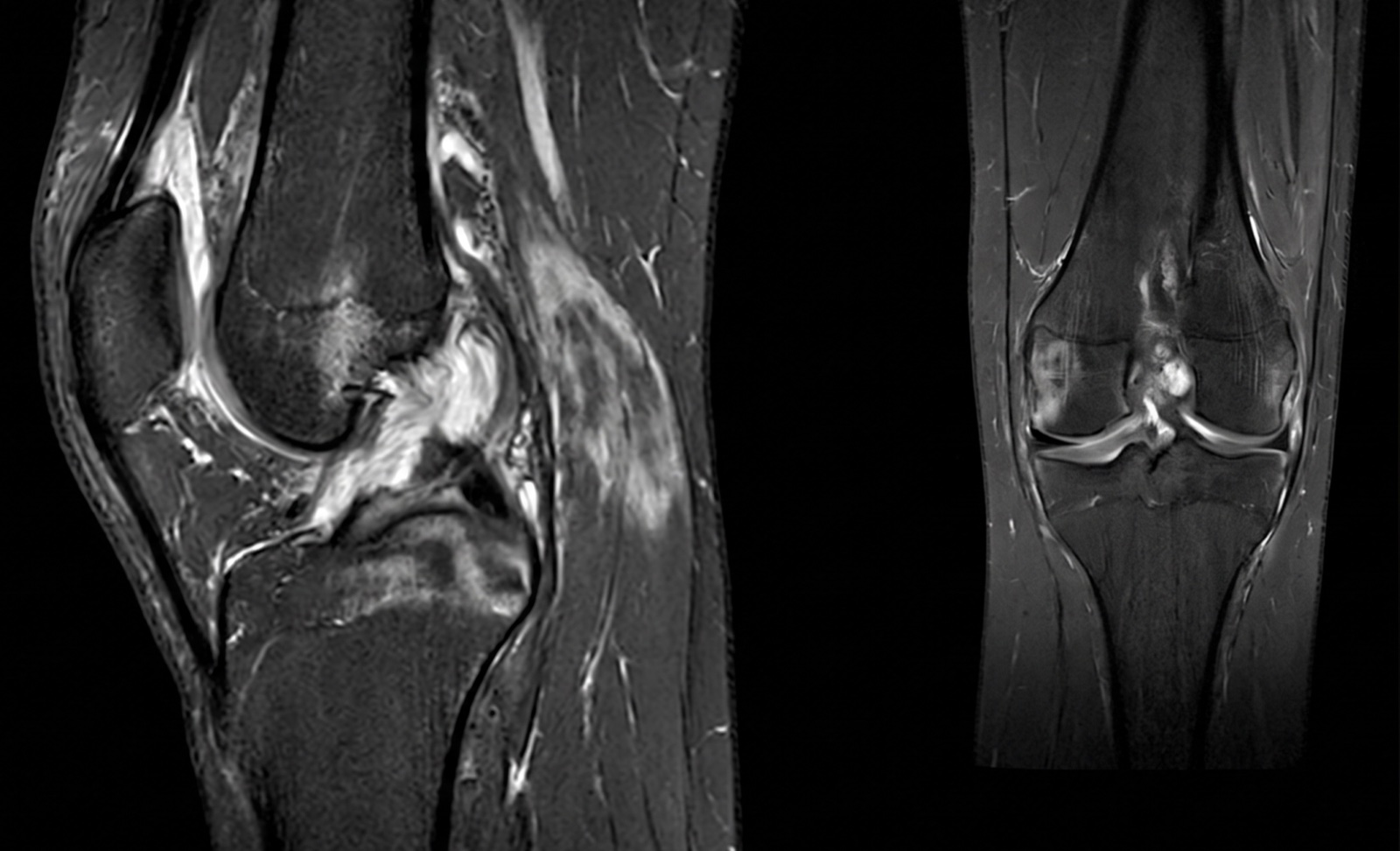 Knee MRI — sagittal and coronal views